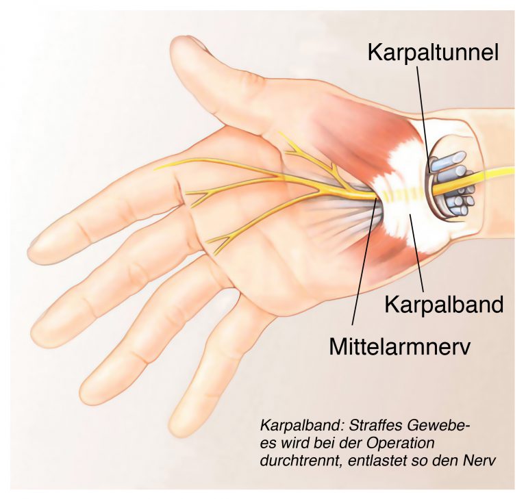 Karpaltunnelsyndrom Heilpraxis