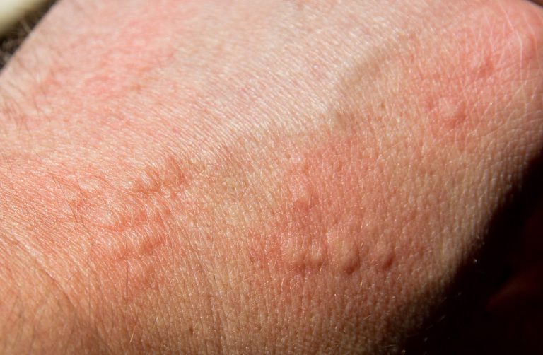 Juckender Hautausschlag Heilpraxis