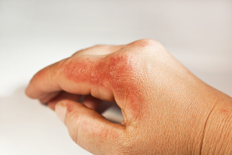 Behandlung Juckender Hautausschlag Heilpraxis