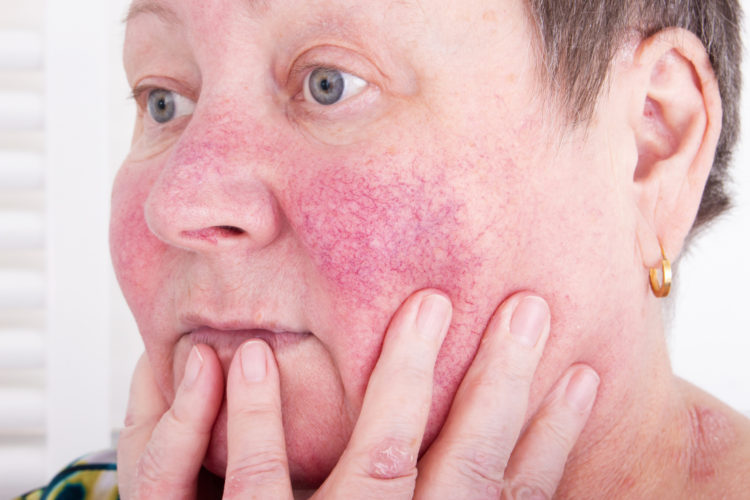 Rote Flecken Im Gesicht Ursachen Und Wirksame Behandlung Heilpraxis