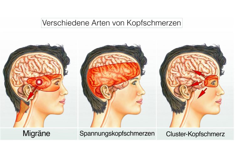 Kopfschmerzen Vom Hinterkopf Ausstrahlend Symptome Ursachen