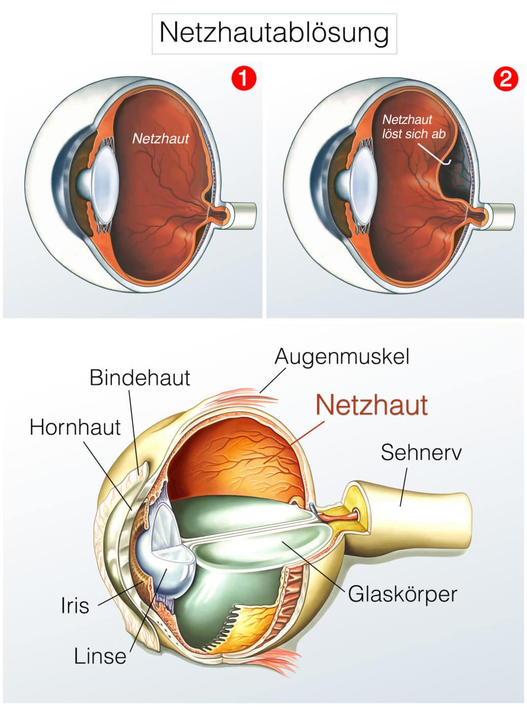 Netzhautentz Ndung Symptome Ursachen Und Behandlung Heilpraxis