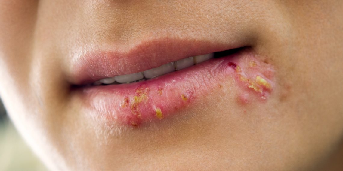 Lippenherpes Vorbeugung Und Behandlung Heilpraxis