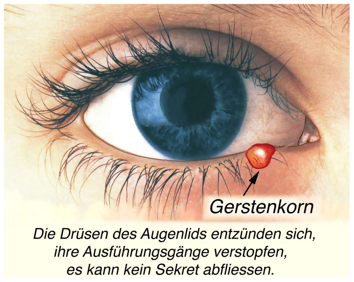 Entzündungen des Augenlids Gerstenkorn Heilpraxis