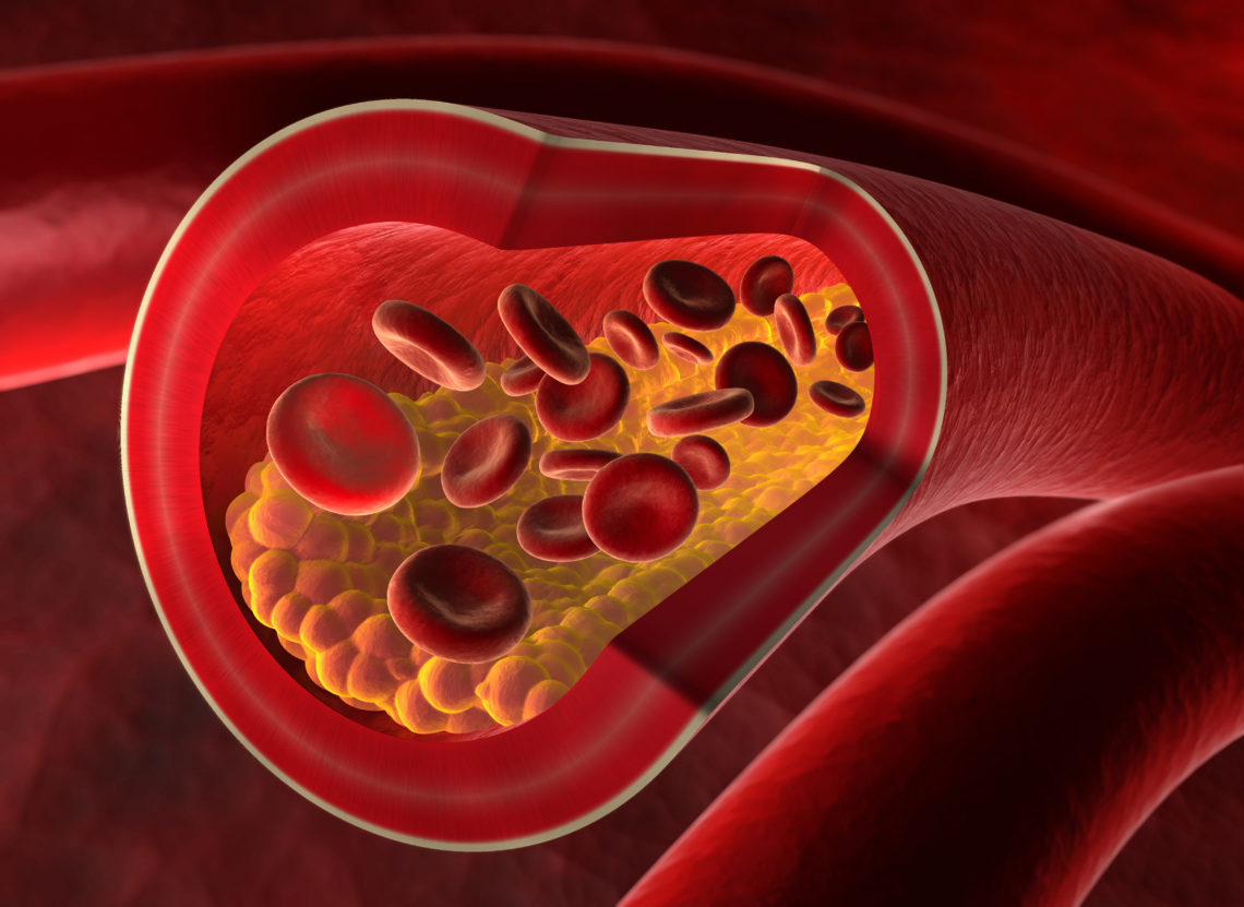 Arterienverkalkung – Symptome, Ursachen Und Therapie – Heilpraxis