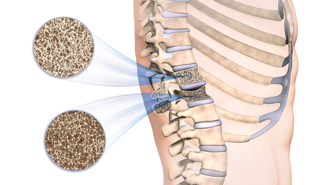 Osteoporose Symptome Ursachen Und Behandlung Heilpraxis