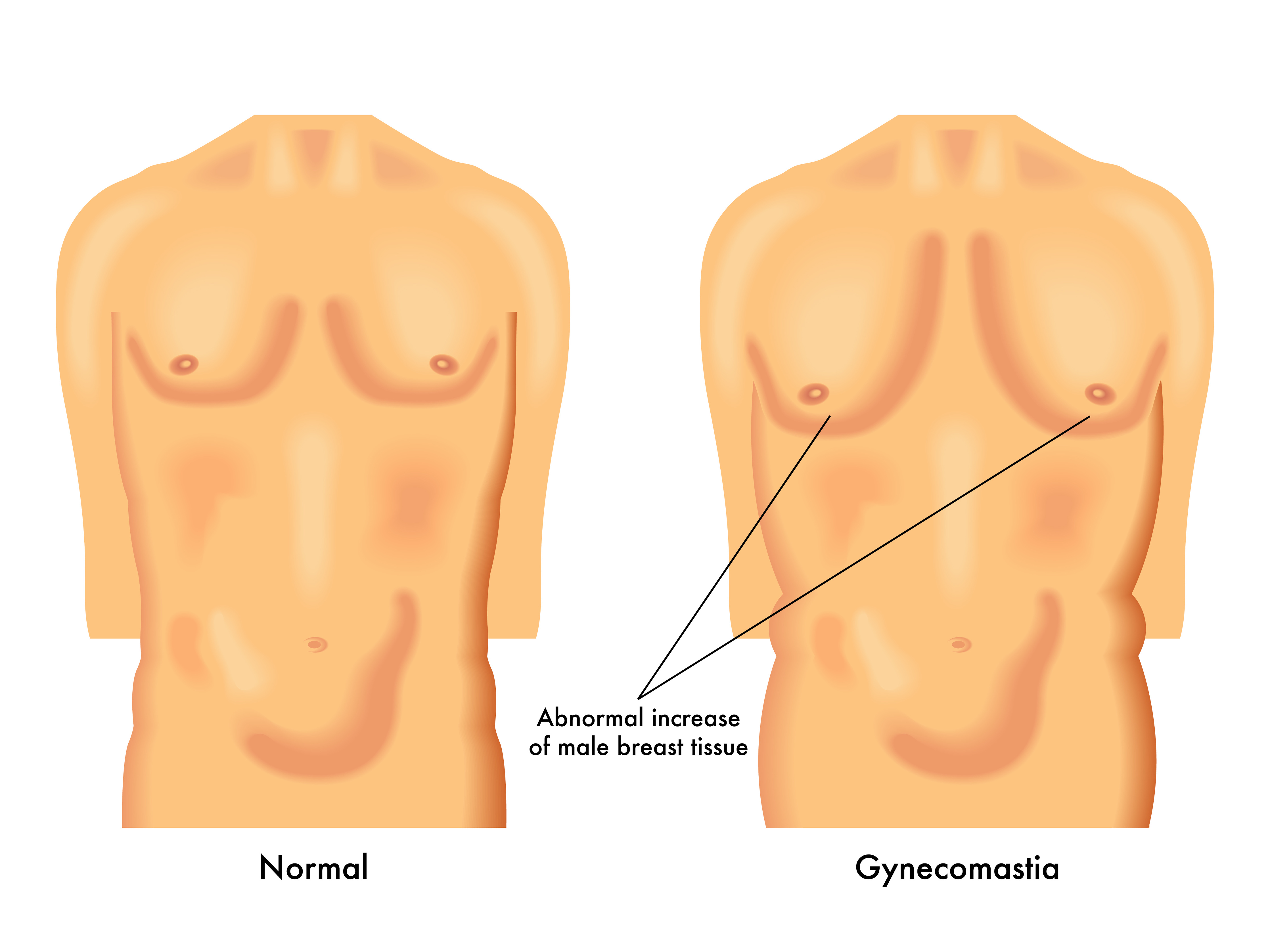 уплотнение на груди слева у мужчин фото 103