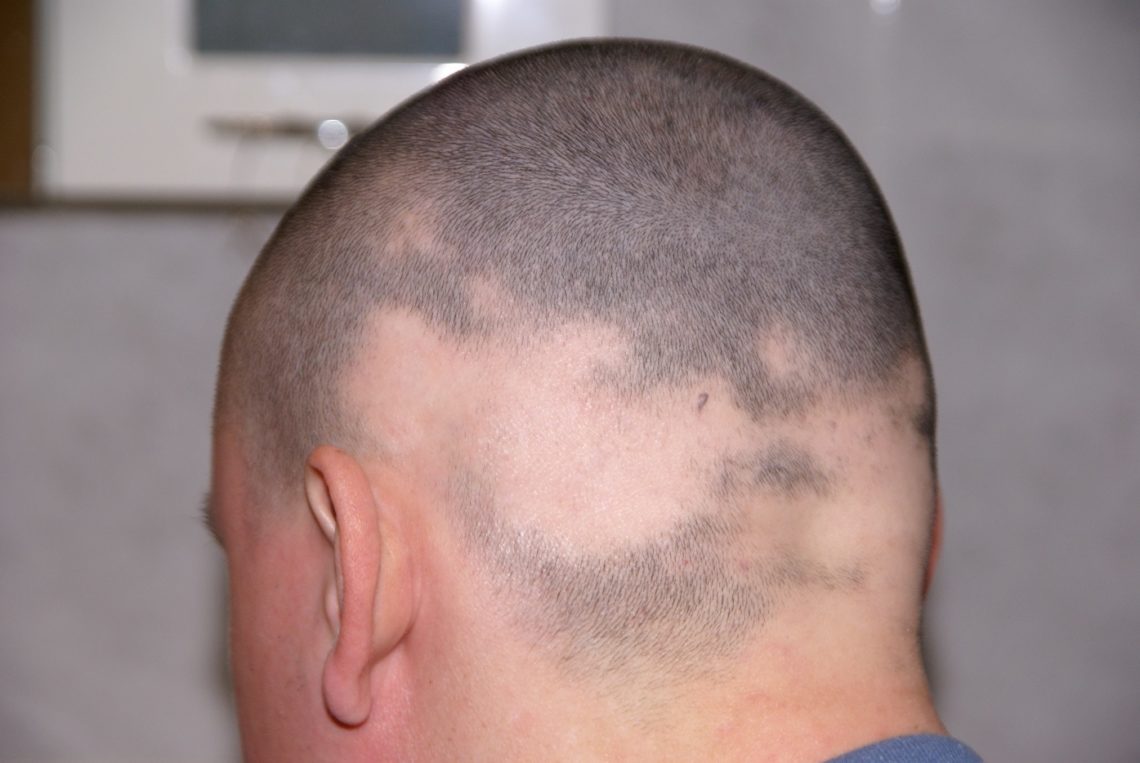 Kreisrunder Haarausfall Heilpraxis