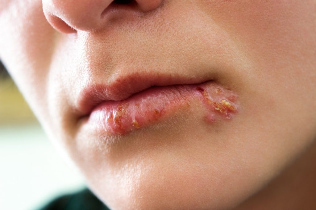 Herpes Im Mund Ausl ser Und Behandlung