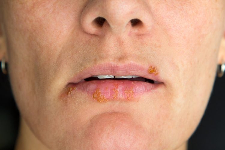 33+ Guertelrose im mund bilder , Neue Therapien Herpes mit körpereigenem Protein behandelbar Heilpraxis