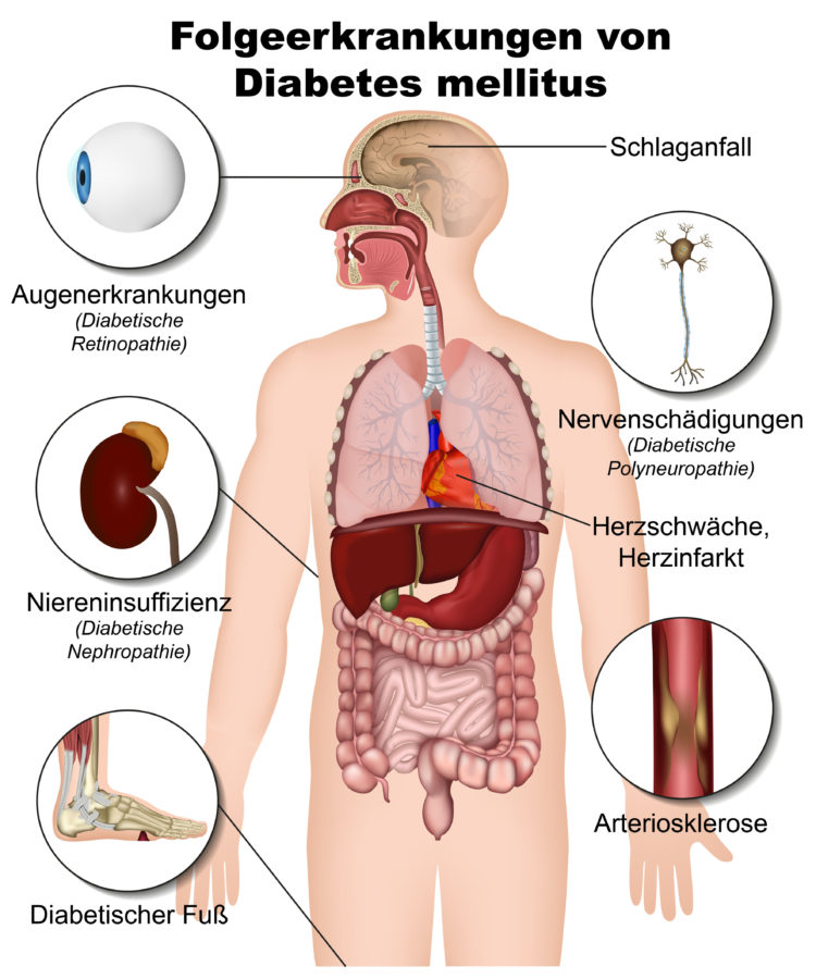 Diabetes Mellitus: Eine chronische Erkrankung mit weitreichenden Komplikationen