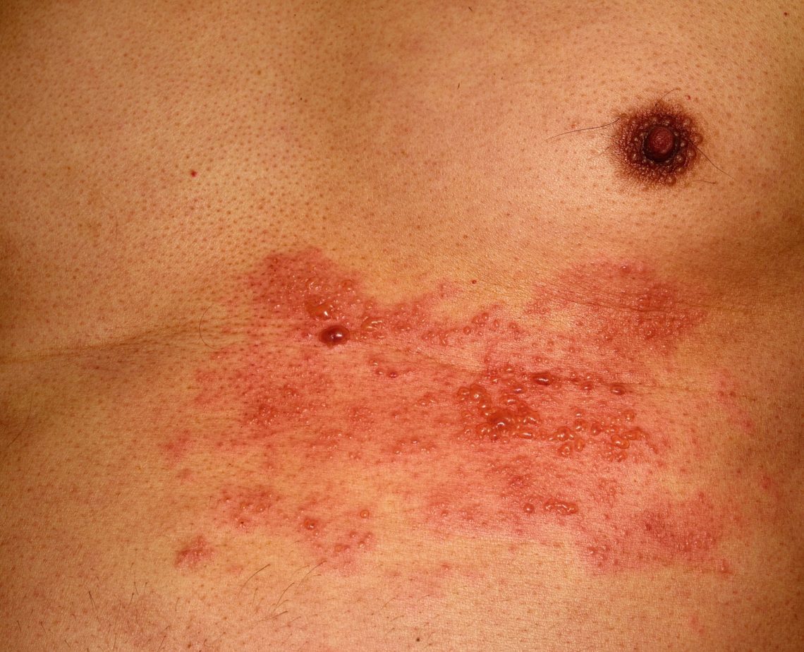 34+ Guertelrose unter der brust bilder , Ausschlag am Bauch Heilpraxis