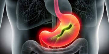 Die Typ-B-Gastritis ist die häufigste Form der chronischen Magenschleimhautentzündung. Sie wird meist durch das Bakterium Helicobacter pylori ausgelöst. (Bild: psdesign1/fotolia.com)