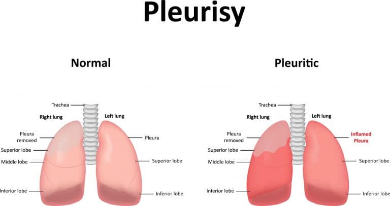 Rippenfellentzündung – Symptome, Diagnose Und Behandlung – Heilpraxis