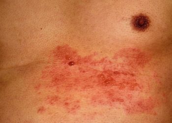 Verschiedene Erkrankungen wie Gürtelrose oder Borreliose können Auslöser für Nervenschmerzen sein. (Bild: hawanafsu/fotolia.com)