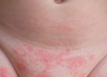 Ein roter und nicht scharf abgegrenzter Hautausschlag in der Windelregion ist das typische Anzeichen einer Windeldermatitis. (Bild: lavizzara/fotolia.com)