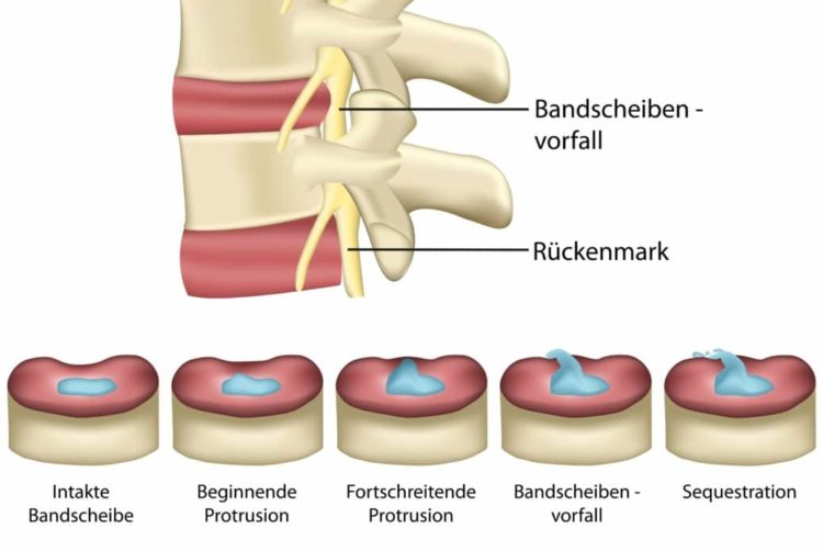 Bandscheibenvorfall: Symptome, Ursachen Und Behandlung – Heilpraxis