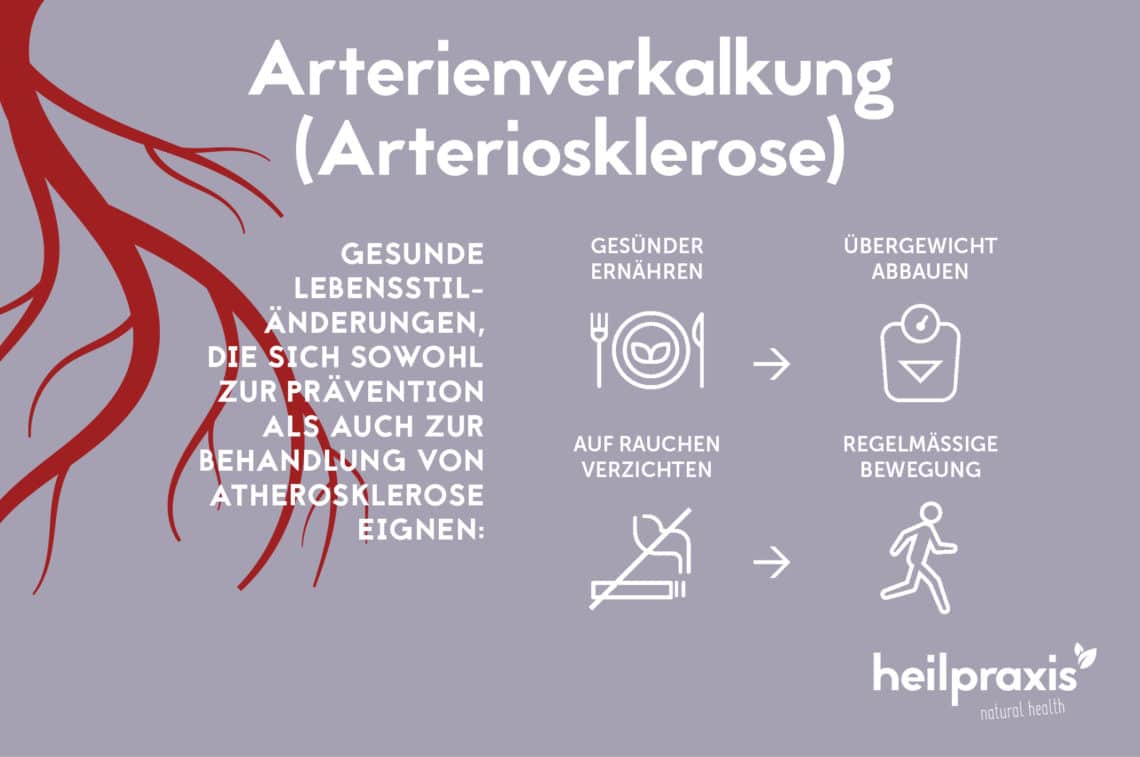 Arterienverkalkung – Symptome, Ursachen Und Therapie – Heilpraxis