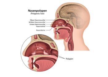 Ein Schaubild über Nasenpolypen (Polyposis nasi).