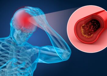 Eine grafische Darstellung über eine verengte Arterie im Gehirn.