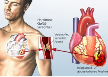 Schaubild Angina Pectoris.