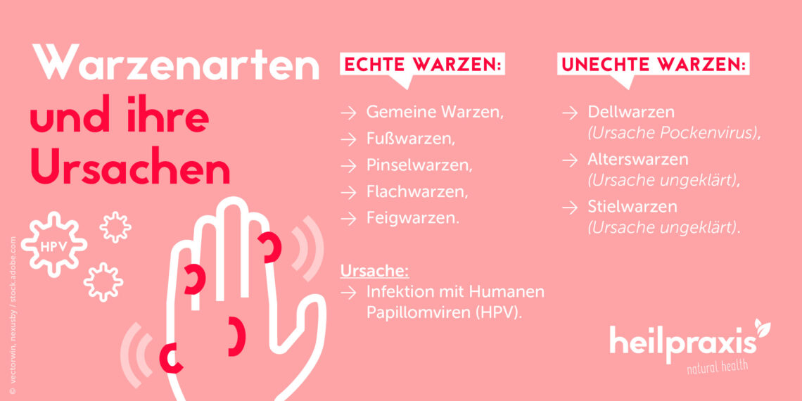 Warzenarten – Ursachen, Symptome Und Behandlung – Heilpraxis